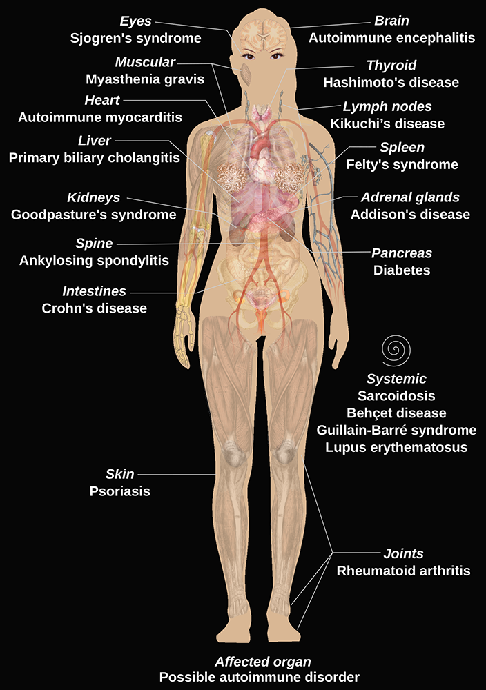 Autoimmune Disease diagram