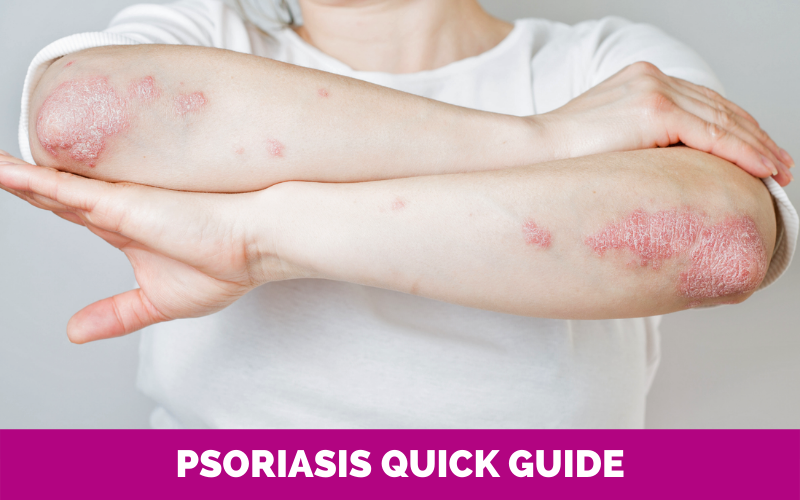 Psoriasis Quick Guide