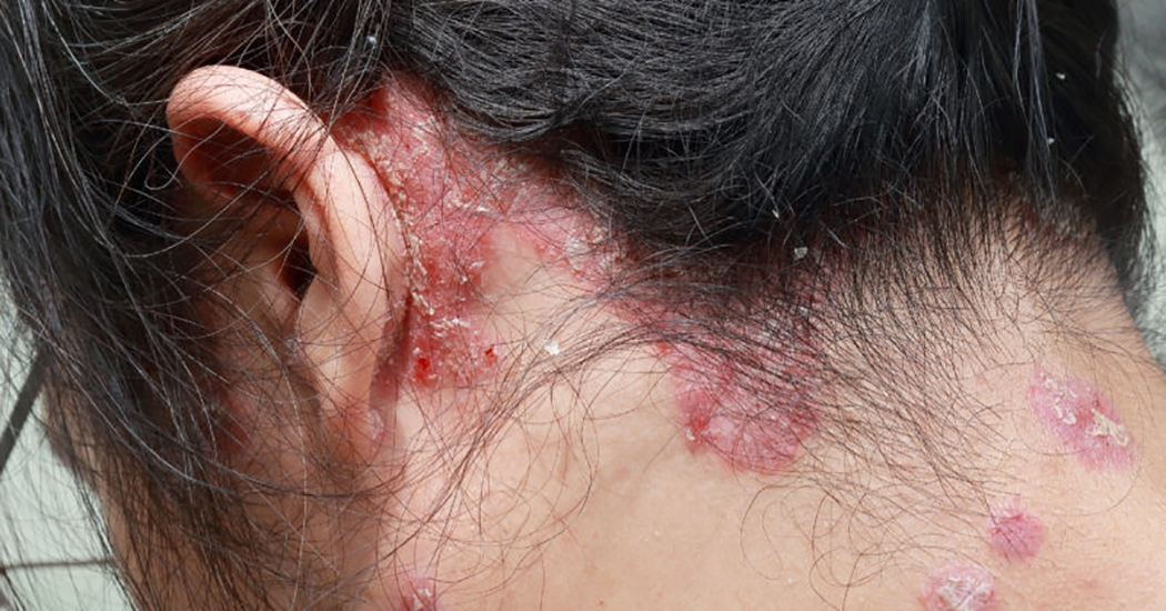 Psoriasis in the scalp