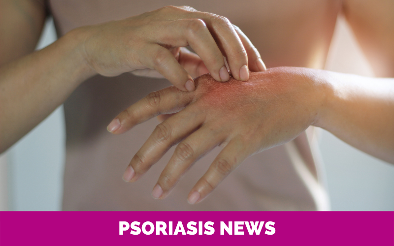 Psoriasis News