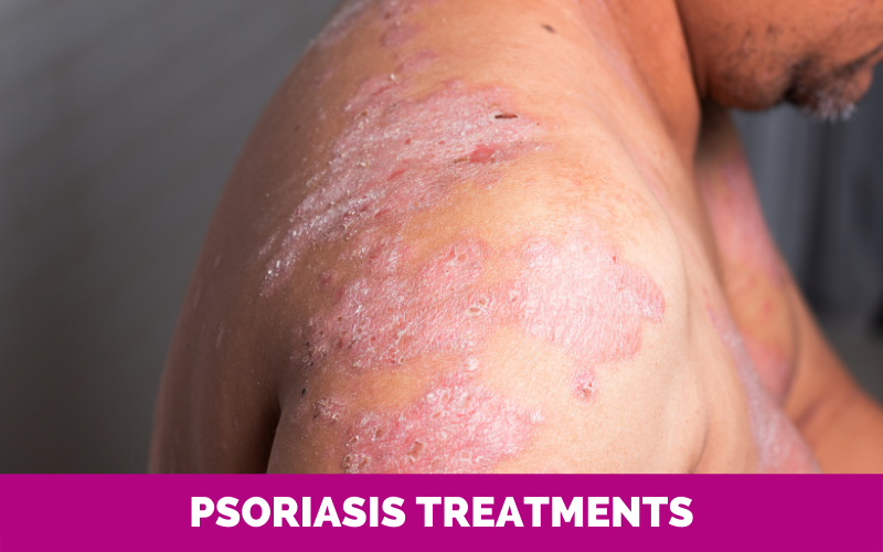 Psoriasis Treatments