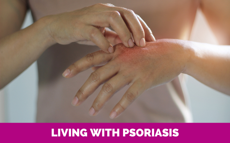 Living with psoriasis