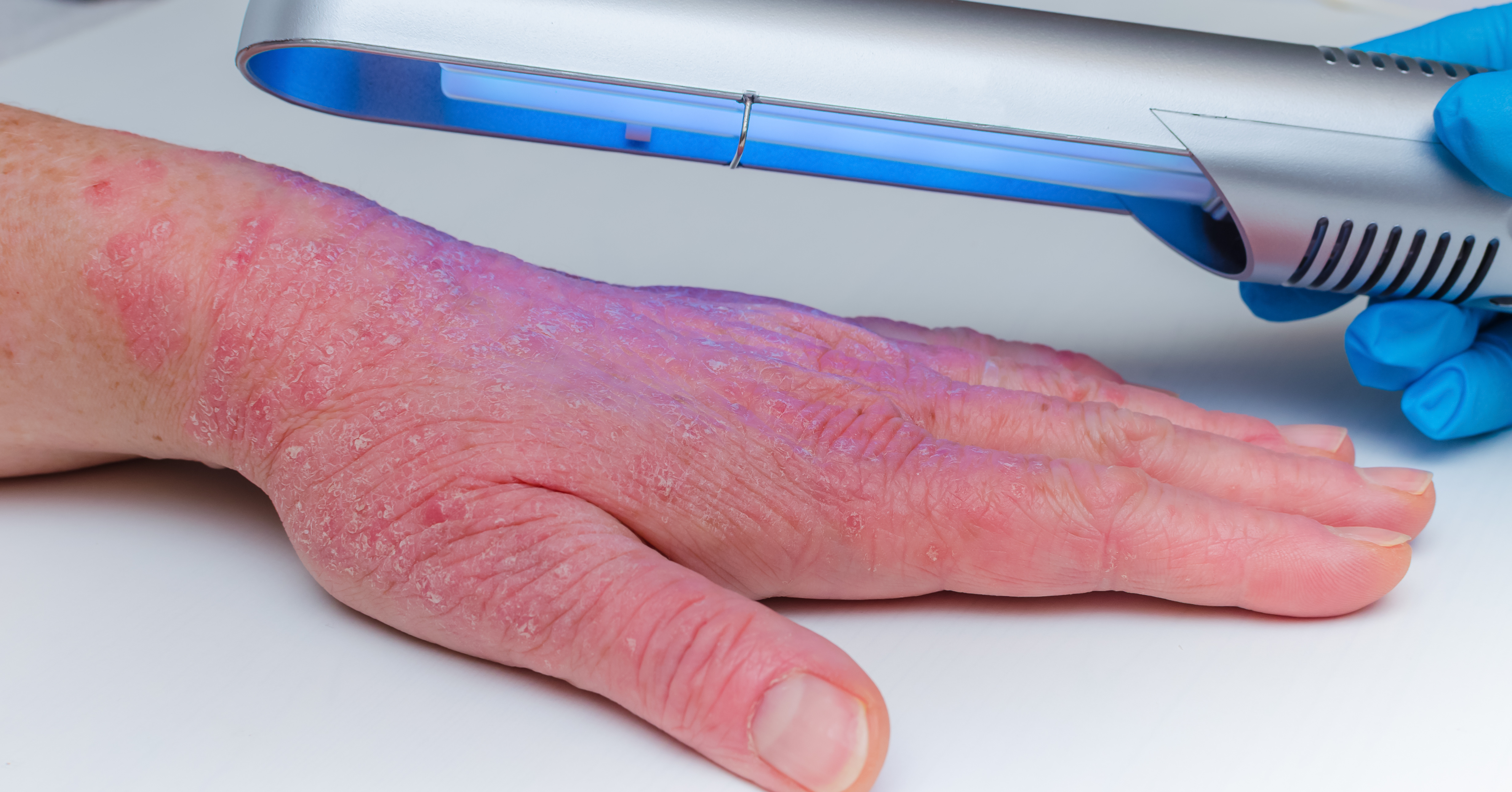 UV light therapy on hand with psoriasis